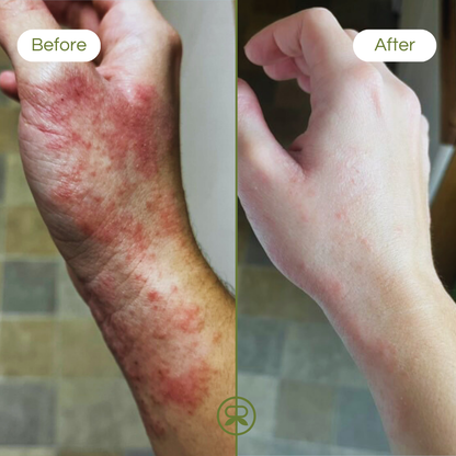 tea tree & lemon balm